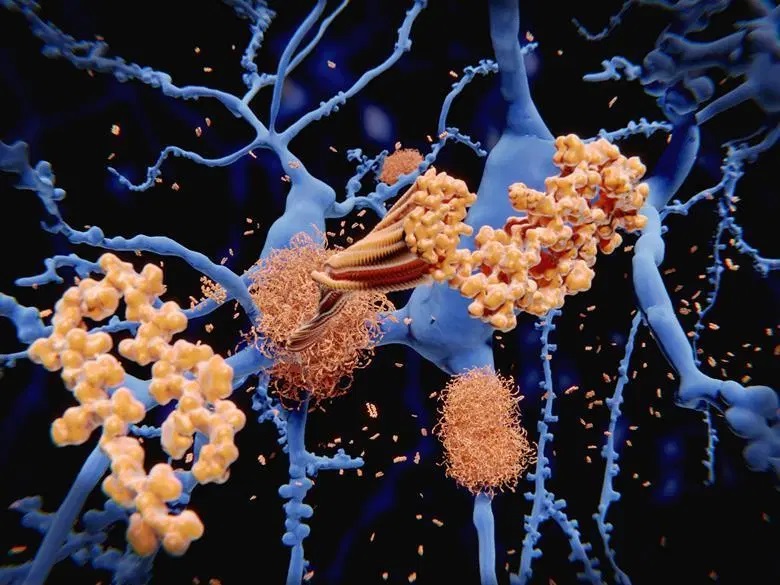 Excess copper from Alzheimer's disease